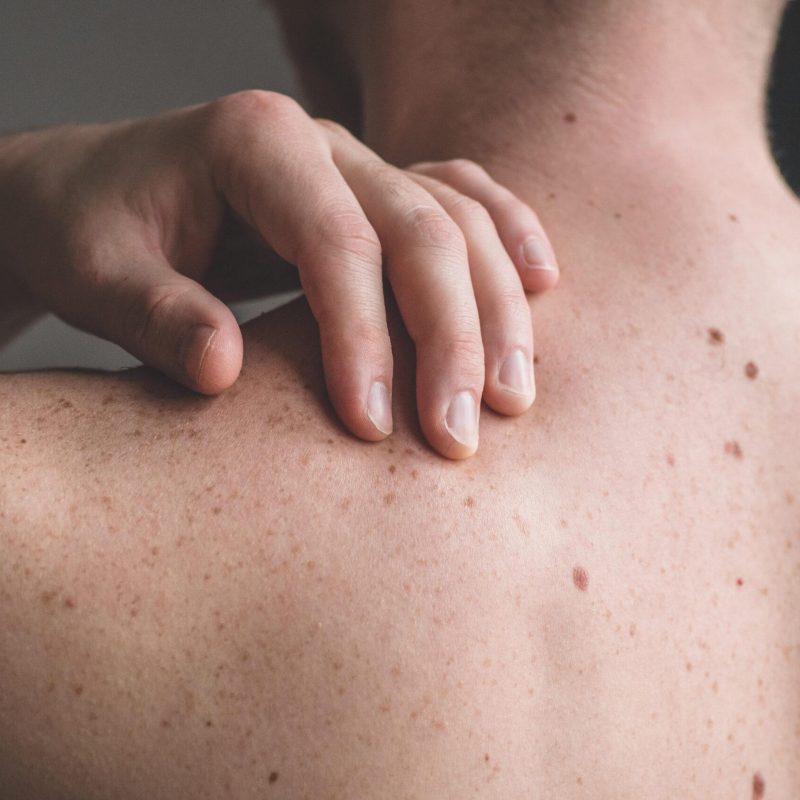 Checking benign moles. Close up detail of the bare skin on a man